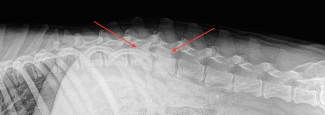 Discospondylitis